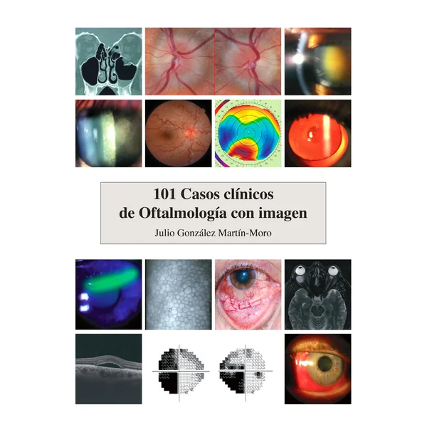 101 Casos Clínicos de Oftalmología con Imagen