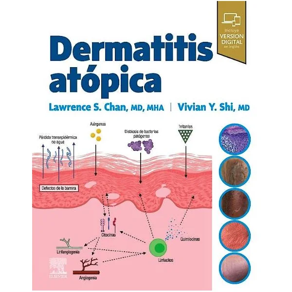 Dermatitis Atópica