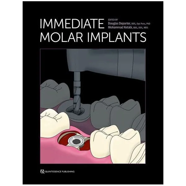 Immediate Molar Implants