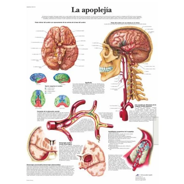 Lámina LA APOPLEJÍA