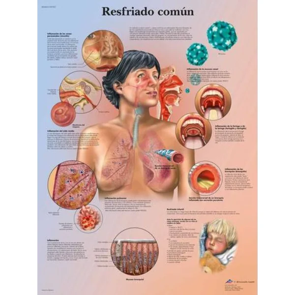 Lámina RESFRIADO COMÚN